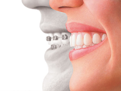 The image is a composite of two photographs  on the left, a close-up of a smiling person s teeth and facial features, and on the right, an overlay of a dental implant with a smiling mouth.