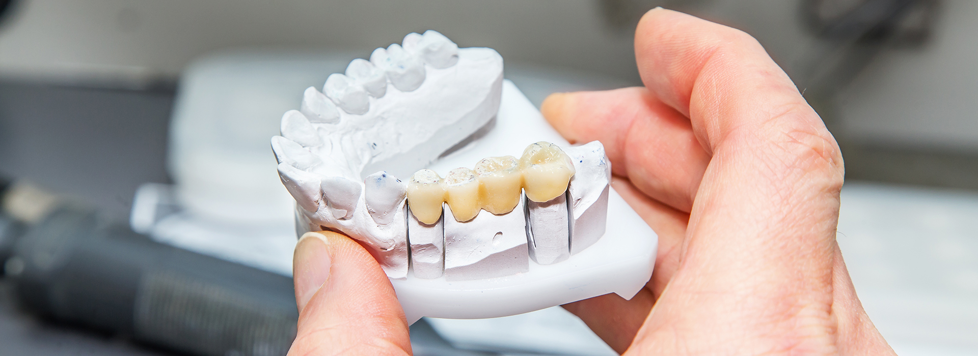 The image shows a person s hand holding a 3D printed dental implant model, which appears to be an upper denture with teeth and gum details.