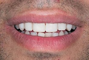 The image shows a close-up of a person s mouth with a wide smile, displaying white teeth and pink gums.