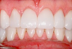 The image shows a close-up view of a person s teeth with visible enamel wear and discoloration, highlighting dental health concerns.