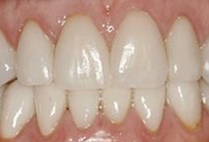 The image shows a close-up view of a person s teeth, which appear white with some yellowing, suggesting a smile with an open mouth.