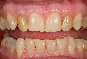 The image features a close-up view of a person s teeth with noticeable yellowing and staining, showcasing a dental issue such as discoloration or poor oral hygiene.