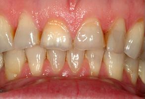 The image shows a close-up view of a person s teeth with visible staining and discoloration, suggesting poor oral hygiene or the need for dental treatment.