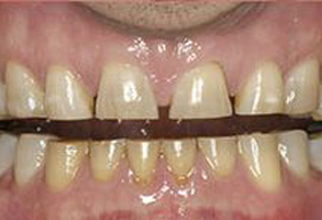 The image shows a person s teeth with visible discoloration and decay, particularly in the front area where some teeth appear to be missing or broken.